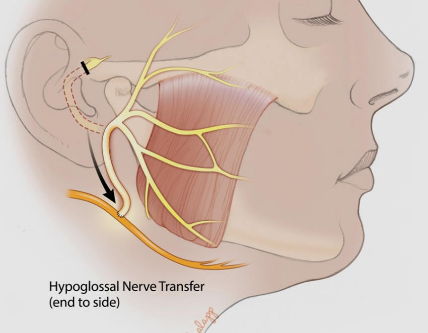 Desenho esquemático mostrando como é realizada uma anastomose do nervo hipoglosso com o nervo facial nos raros casos de paralisia facial pós-operatória.